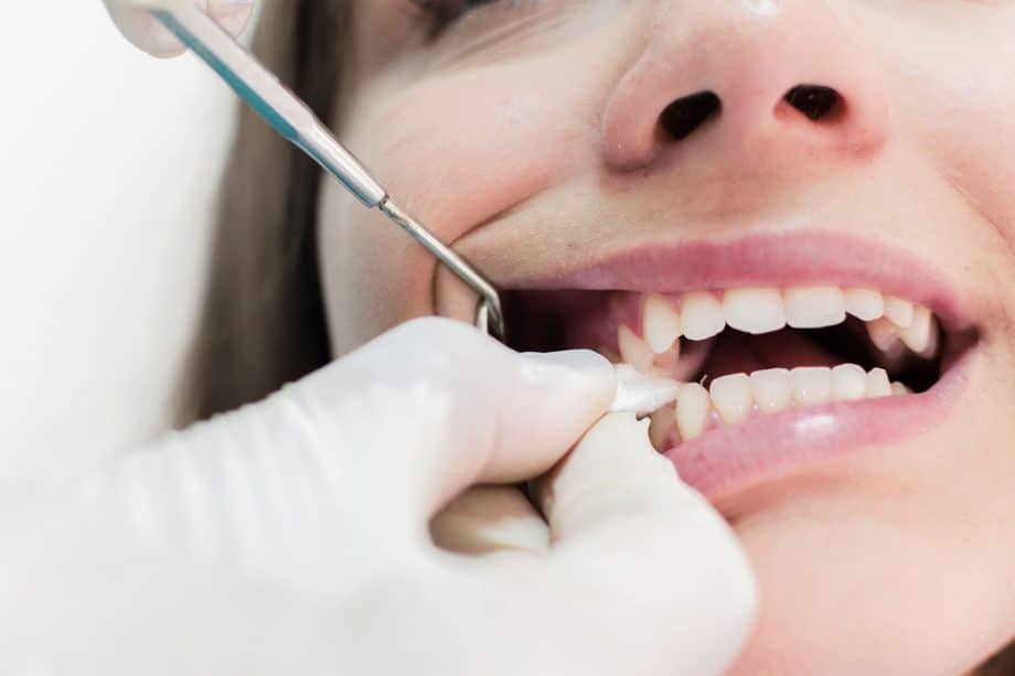 How Long Should You Use Gauze After a Tooth Extraction?